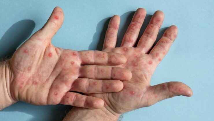 Maymun çiçeğinin yayılmasını engellemenin en etkili yolları