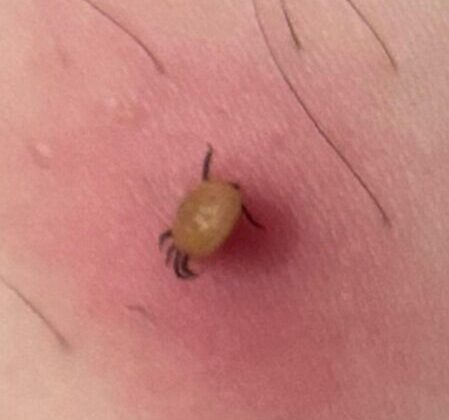 “Bir ısırıkla ölüm: KKKA vakasında korkutan artış”